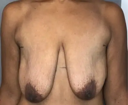 Before Image: Breast Augmentation - front