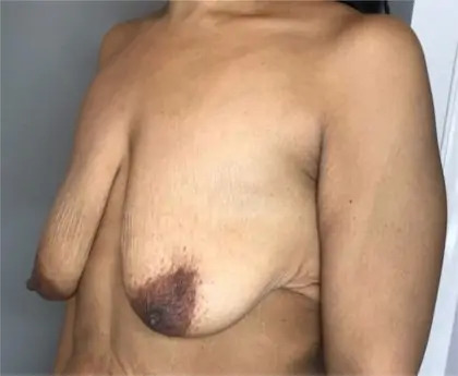 Before Image: Breast Augmentation - left-front-oblique