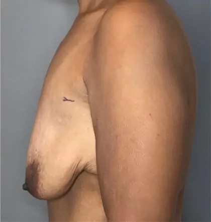 Before Image: Breast Augmentation - left-side