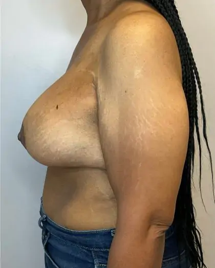 After Image: Breast Augmentation - left-side