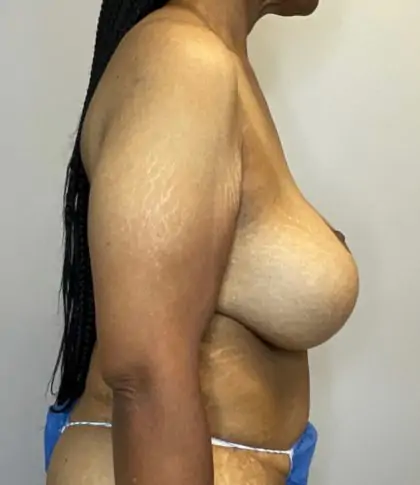 Before Image: Breast Augmentation - right-side
