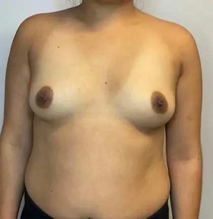 Before Image: Breast Augmentation - front