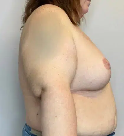 After Image: Breast Lift, Breast Reduction - right-side
