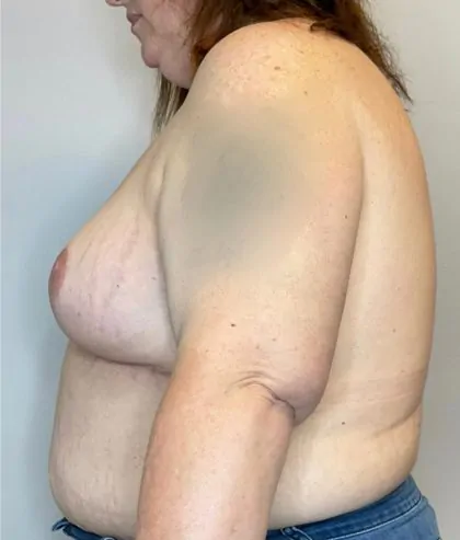 After Image: Breast Lift, Breast Reduction - left-side