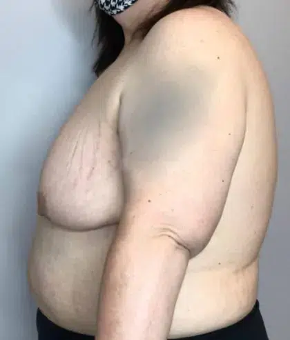 Before Image: Breast Lift, Breast Reduction - left-side