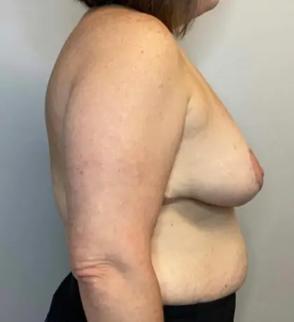 After Image: Breast Reduction - right-side