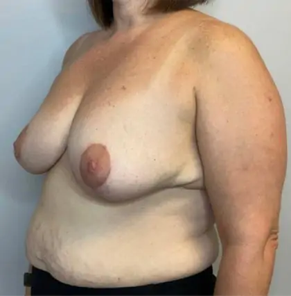 After Image: Breast Reduction - left-front-oblique