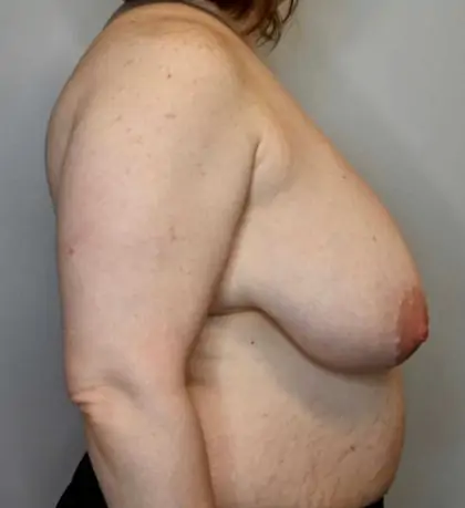 Before Image: Breast Reduction - right-side