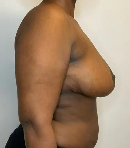 After Image: Breast Reduction - right-side