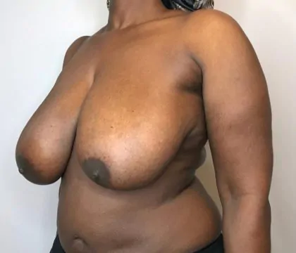 Before Image: Breast Reduction - left-front-oblique