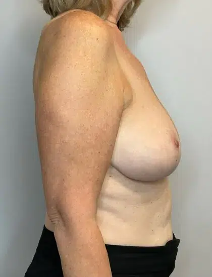 After Image: Breast Reduction - right-side