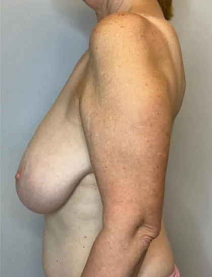 Before Image: Breast Reduction - left-side