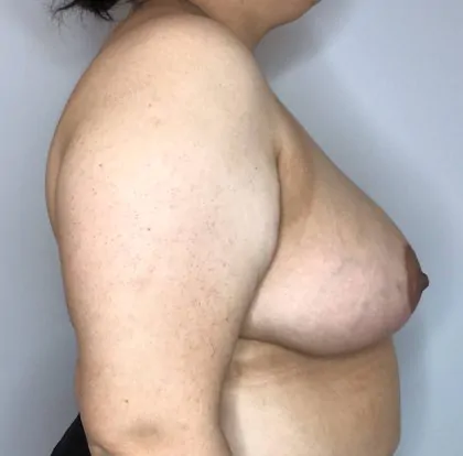 After Image: Breast Reduction - right-side