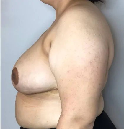 After Image: Breast Reduction - left-side