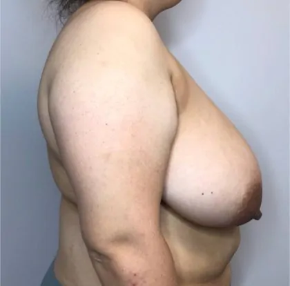Before Image: Breast Reduction - right-side