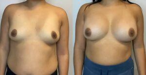 Before & After Image of Mammoplasty Wake Forest NC