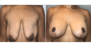 Before & After Image of Breast Augmentation Wake Forest NC