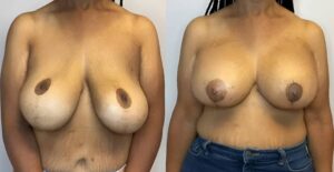 Before & After Image of Breast Augmentation Raleigh NC