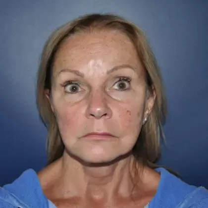 After Image: Facelift - front