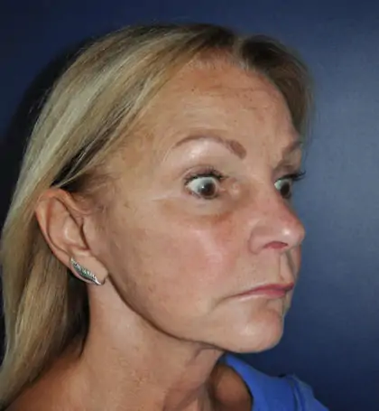 After Image: Facelift - right-front-oblique