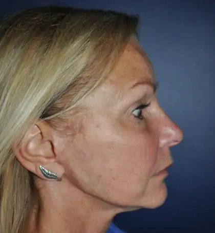 After Image: Facelift - right-side