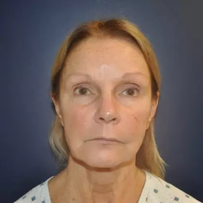 Before Image: Facelift - front