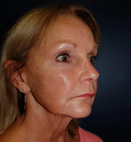Before Image: Facelift - right-front-oblique
