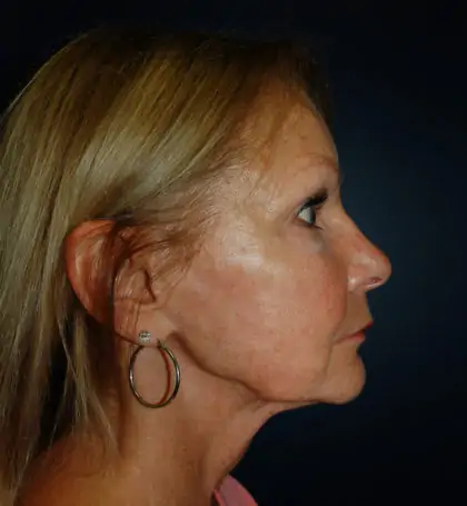Before Image: Facelift - right-side