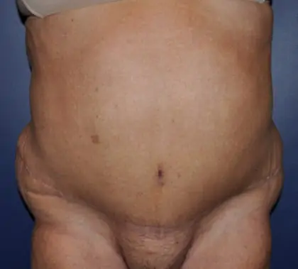 After Image: Liposuction, Tummy Tuck - front