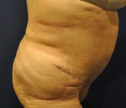 After Image: Liposuction, Tummy Tuck - right-side