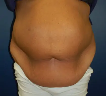 Before Image: Liposuction, Tummy Tuck - front
