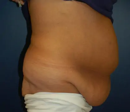 Before Image: Liposuction, Tummy Tuck - right-side