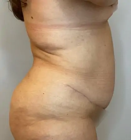 After Image: Liposuction, Tummy Tuck - right-side