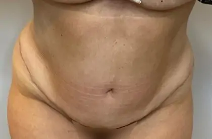 After Image: Liposuction, Tummy Tuck - front