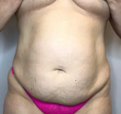 Before Image: Liposuction, Tummy Tuck - front