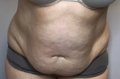 Before Image: Liposuction, Tummy Tuck - front