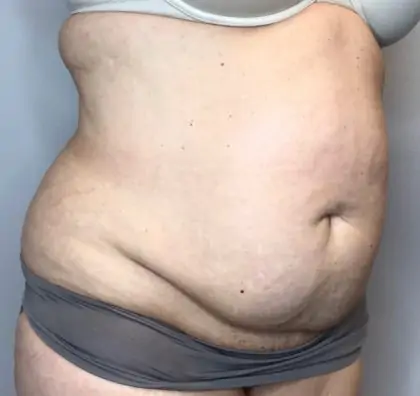 Before Image: Liposuction, Tummy Tuck - right-front-oblique