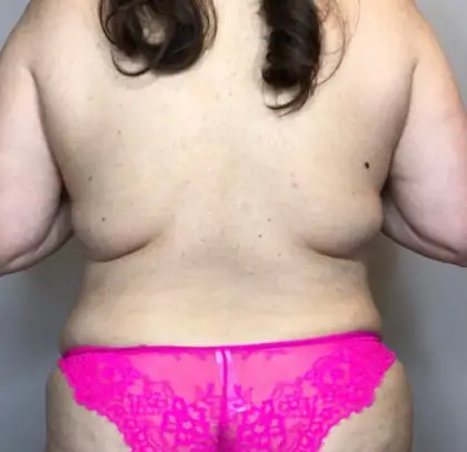 Before Image: Liposuction, Tummy Tuck - back