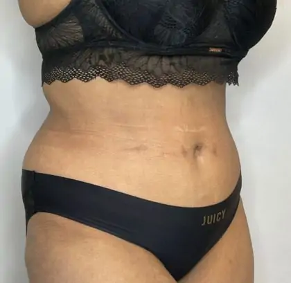 After Image: Liposuction, Tummy Tuck - right-front-oblique