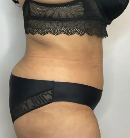 After Image: Liposuction, Tummy Tuck - right-side