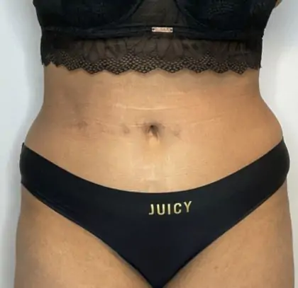 After Image: Liposuction, Tummy Tuck - front