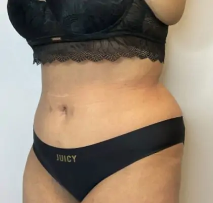 After Image: Liposuction, Tummy Tuck - left-front-oblique