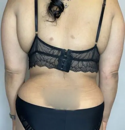 After Image: Liposuction, Tummy Tuck - back
