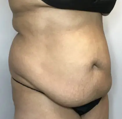 Before Image: Liposuction, Tummy Tuck - right-front-oblique