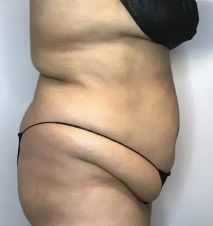 Before Image: Liposuction, Tummy Tuck - right-side