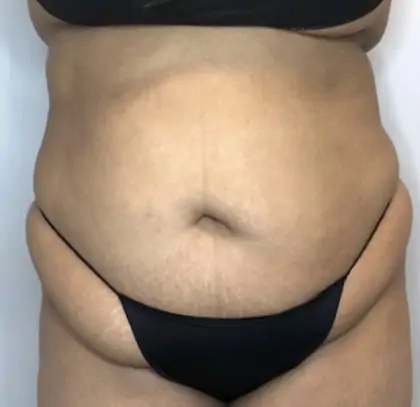 Before Image: Liposuction, Tummy Tuck - front
