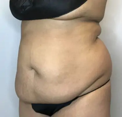 Before Image: Liposuction, Tummy Tuck - left-front-oblique