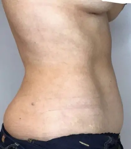 After Image: Liposuction - right-side