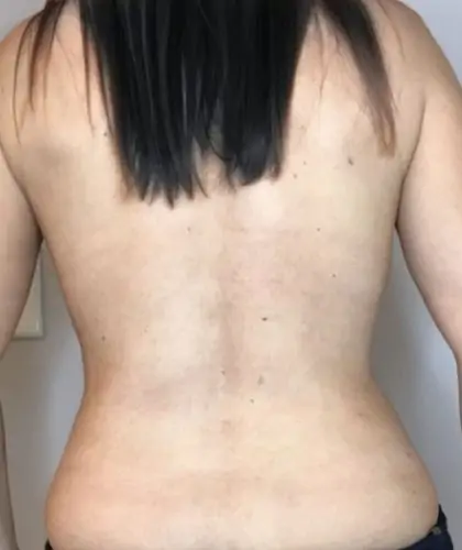 After Image: Liposuction - back