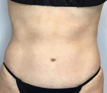 Before Image: Liposuction - front